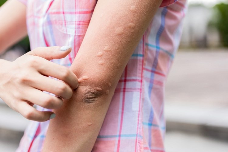 一般而言，被蚊子叮的腫包通常會自行消退，其實反而害怕的是民眾過度搔癢，造成皮膚受損，容易引發感染<br />圖／常春月刊提供