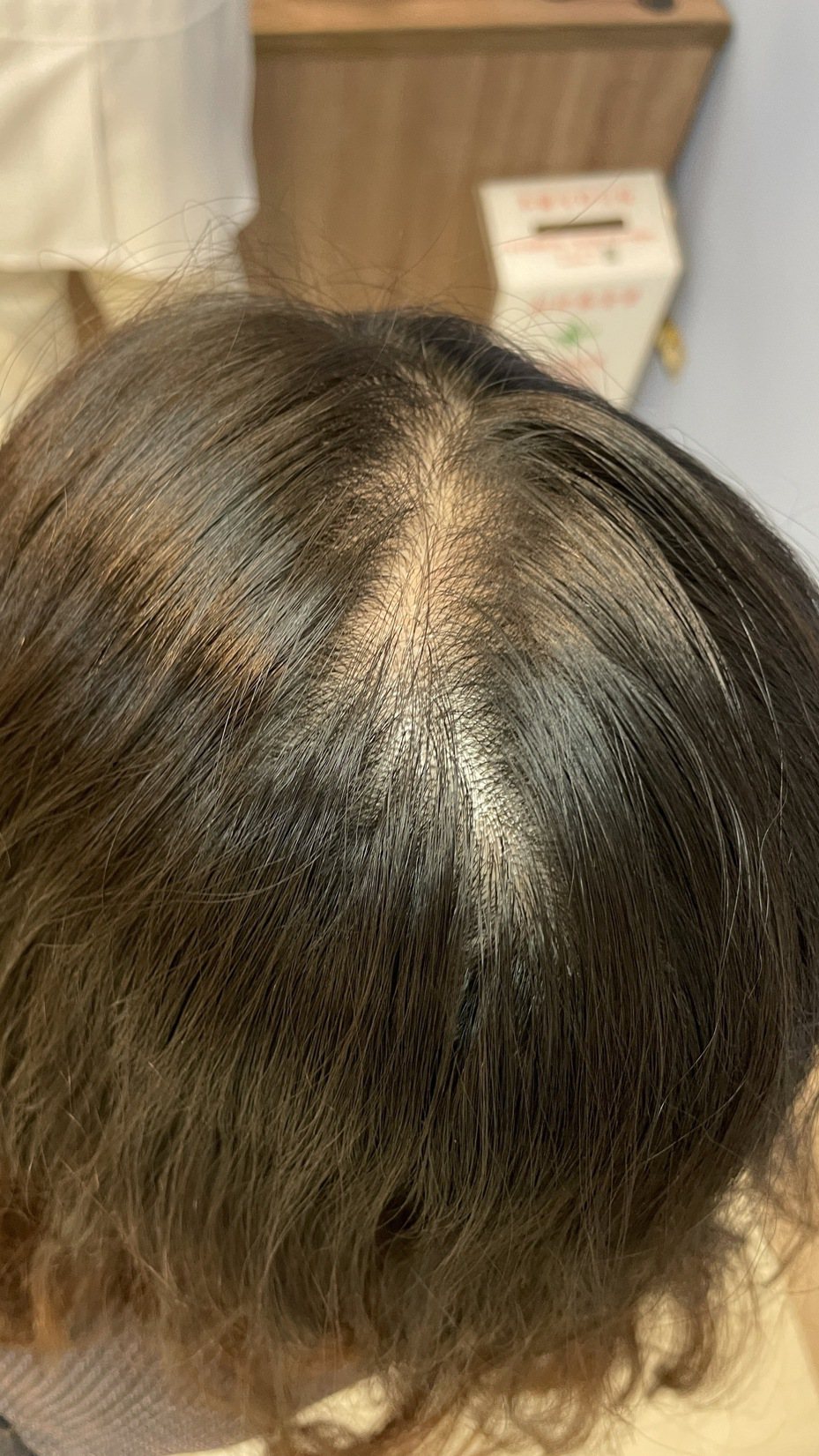 醫師方心禹提醒，若有髮際線變寬、髮質變細軟，就得當心掉髮的問題，務必諮詢醫師意見。圖／亞大醫院提供