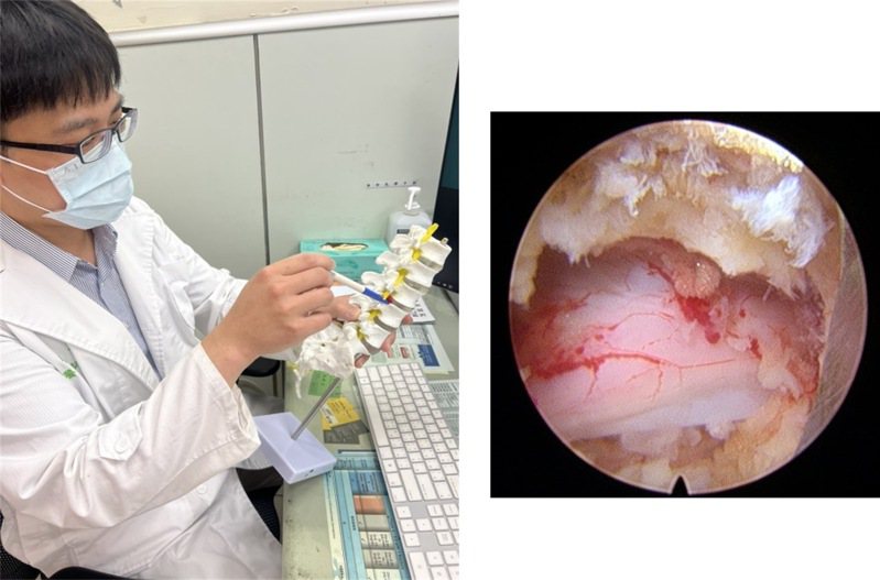新竹臺大分院骨科部醫師王俊傑表示，脊椎內視鏡細如筆狀，可經過1公分不到的傷口抵達病灶。圖／新竹臺大分院提供
