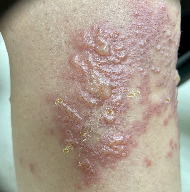一名20多歲女性潛水時，右膝不慎觸碰火珊瑚，導致皮膚出現局部波浪狀紅疹及水泡。圖／陳威宇醫師提供