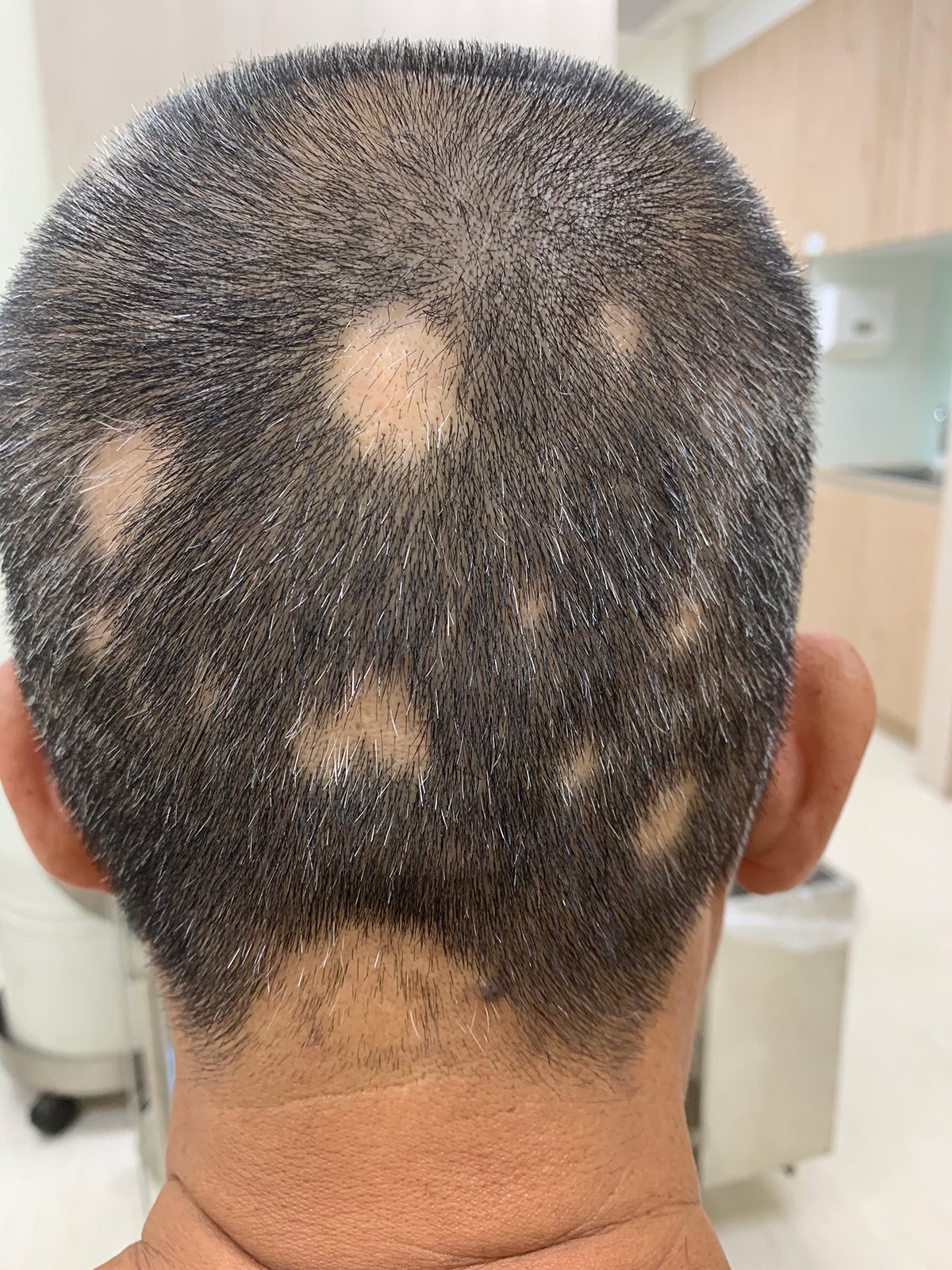 壓力大導致鬼剃頭，是除了遺傳雄性禿以外，最常見的掉髮原因。圖/黃星瑋醫師提供
