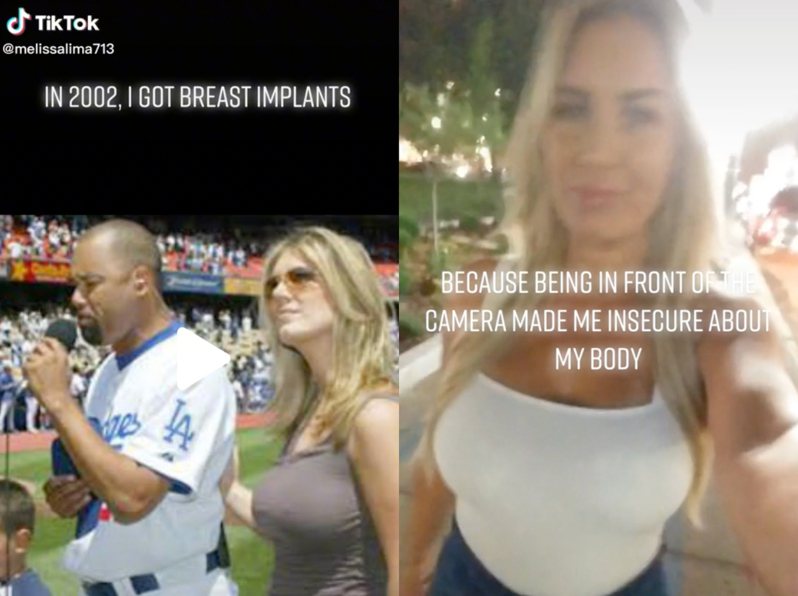 美國女子梅麗莎（Melissa Lima）曾於20年前隆乳植入鹽水袋，讓自己的胸部看起來更雄偉美觀。 圖擷自TikTok@melissalima713