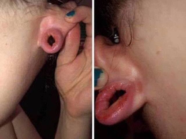 女事主在facebook上传照片，称男友在亲热时提出要将阴茎穿过她的耳洞，结果令她耳垂部位发炎。（网上图片）(photo:UDN)