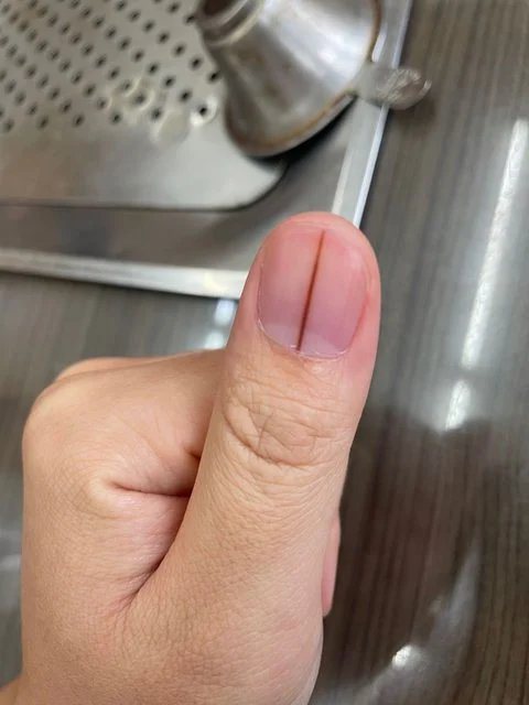 有網友大拇指指甲中央上長出一條深色的直線，多人勸他快就醫。圖/Dcard