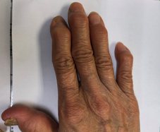 手指關節變形，並在末端指節處甚至形成腫塊。圖/亞東醫院提供
