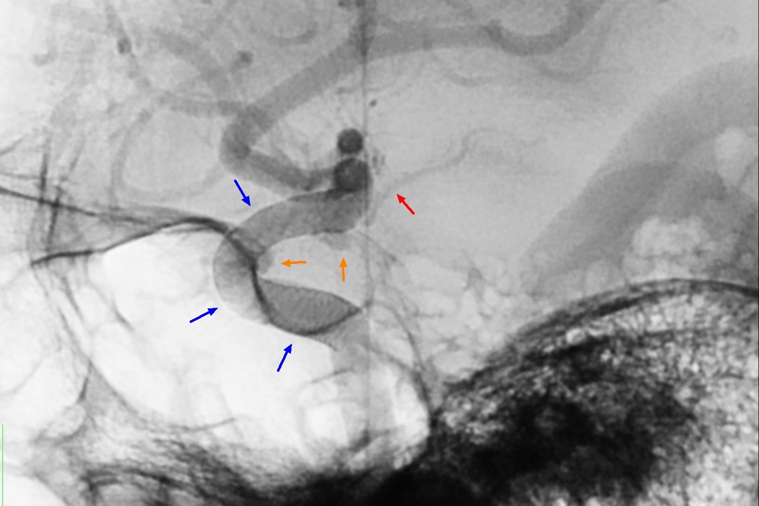衛福部台北醫院神經放射科醫師胡成全指出，手術時要小心避開前脈絡叢動脈（紅箭頭標示處），以血流導向裝置（藍箭頭標示處），治療2顆腦動脈瘤（橘箭頭標示）。圖／台北醫院提供