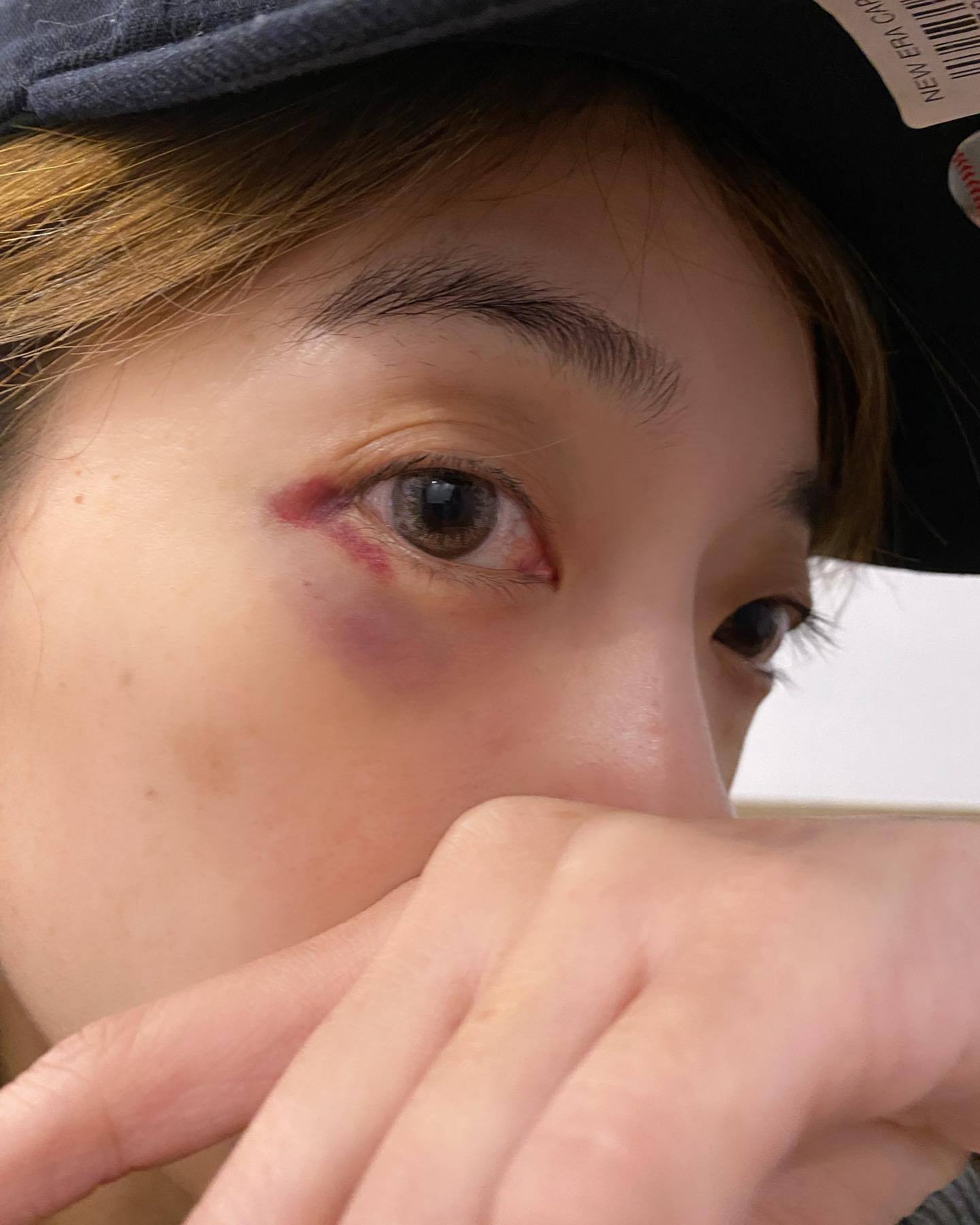 貝童彤分享眼角受傷照，瘀青一大片相當驚人。圖／摘自臉書