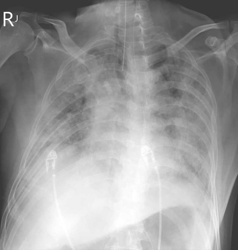蘇一峰PO出一名大陸台商「大白肺」X光片，該名患者已嚴重肺炎，現在插管病危。圖／取自蘇一峰臉書