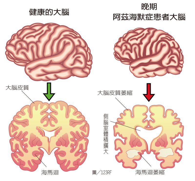 健康大腦與阿茲海默症患者大腦。製表／元氣周報 圖／123RF
