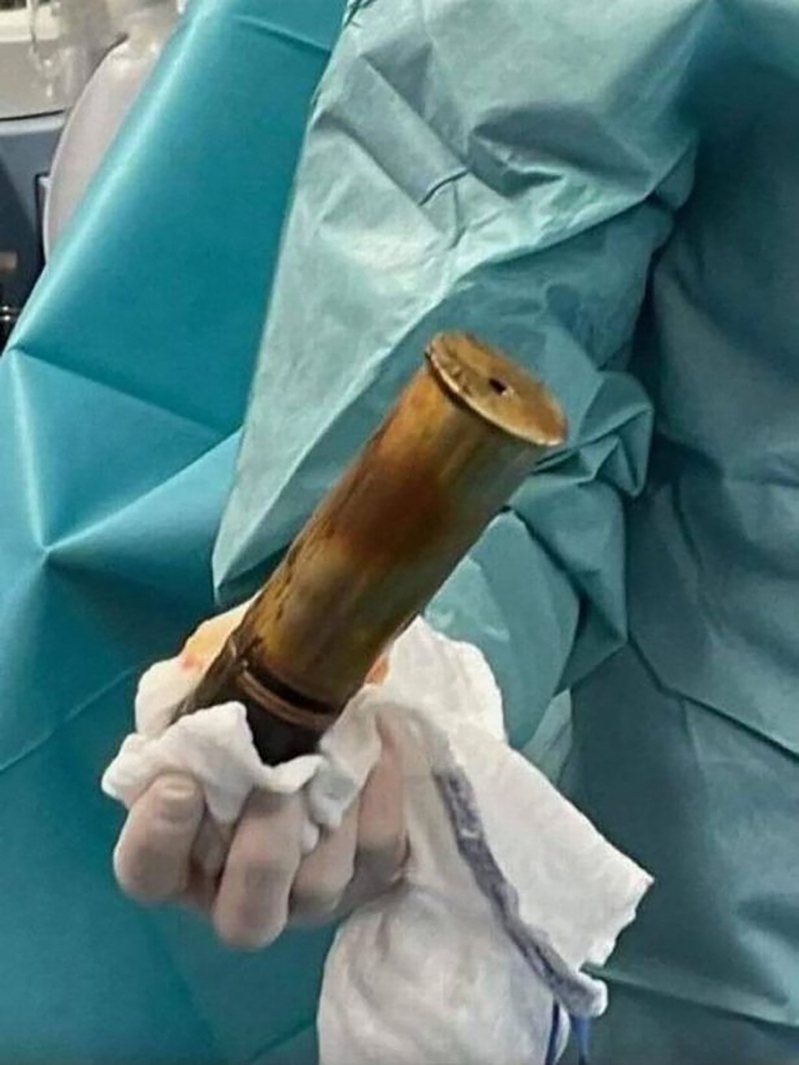 法國一名老翁體內竟卡著20cm的一戰砲彈，醫院發現後一度陷入緊急狀態疏散全院。翻攝自Twitter / @acommonlawyer