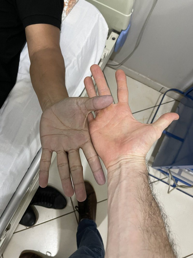 男子因為手部發紫，以為有嚴重疾病趕緊到急診室檢查。圖擷自推特