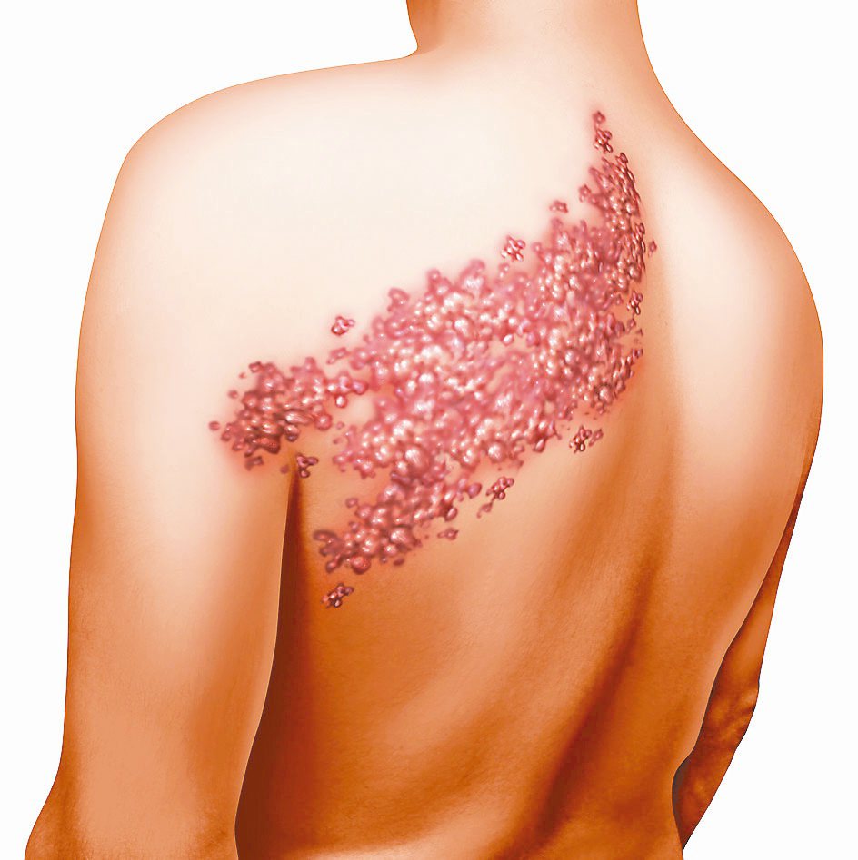 帶狀疱疹是由水痘帶狀疱疹病毒所引起的皮膚病，好發於春秋。圖／123RF