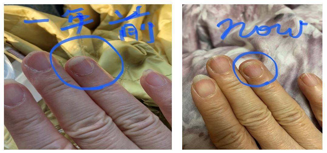 一名50多歲女性，1年多年自覺「手指甲越來越短」，原以為是指甲先前受傷所引起，就醫檢查後發現其25-羥基維生素D偏低，醫師建議每日補充維生素、鈣質，3個月後指甲狀況逐步改善。圖／書田診所提供