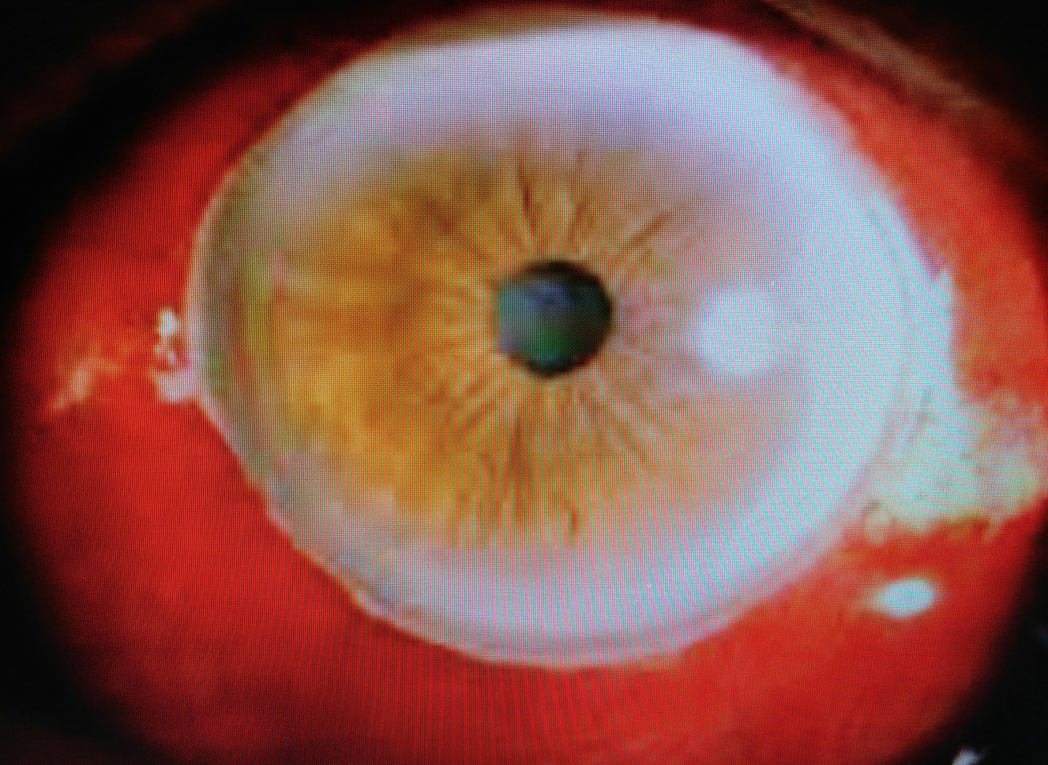 達特楊眼科聯盟執行長洪啟庭醫師收治個案，患者結膜下出血的左眼，變成嚴重的結膜血腫...