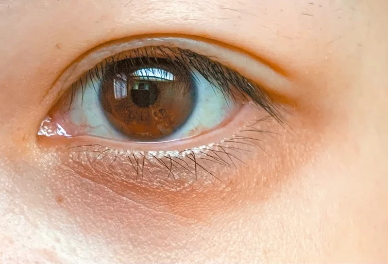 過敏性鼻炎的患者眼下會出現一條細紋，稱為「丹尼爾線」，如果同時有黑眼圈、紅鼻子、...