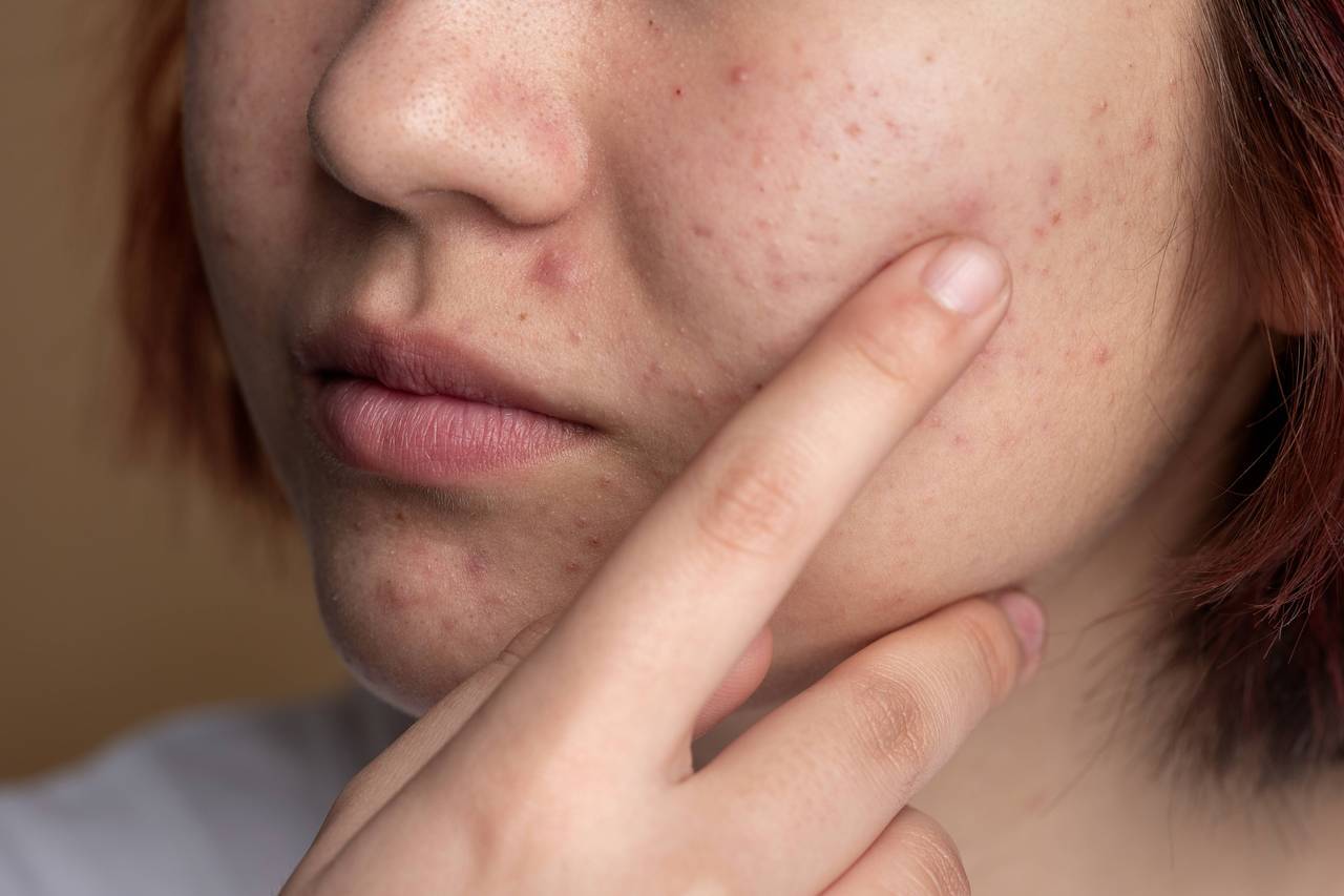 玫瑰斑是一種慢性皮膚炎，於臉部會出現反覆或持續泛紅、發熱、丘疹、膿皰、搔癢、乾粗...