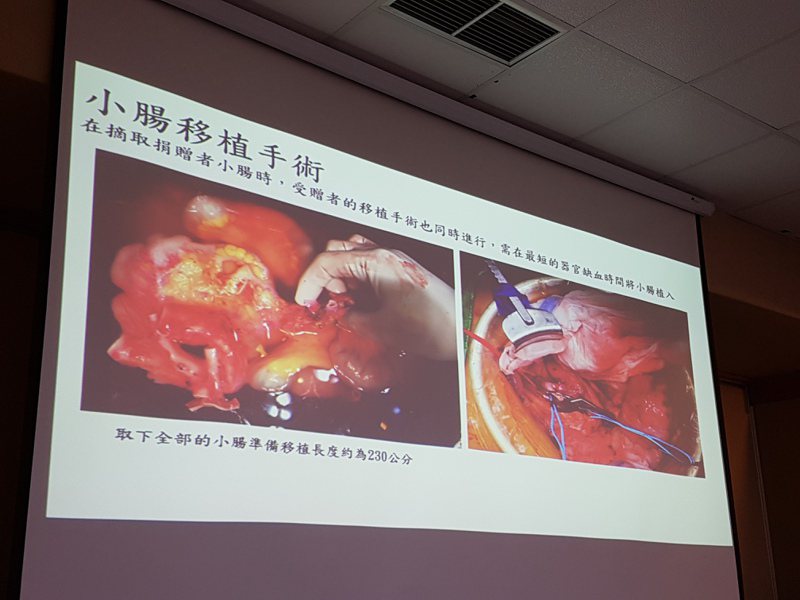 小腸移植手術困難，全世界一年不到100例。

本報資料照片
