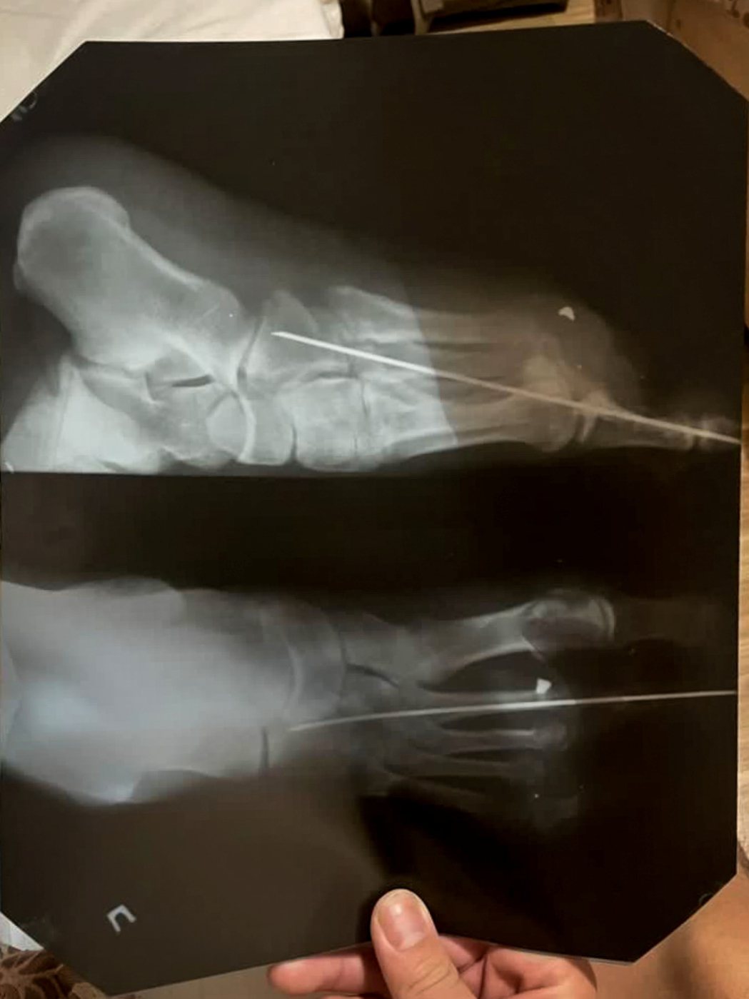 圖為Cai傷後一個月照的X光片，腳趾附近白色的一塊是砲彈的碎片。 圖／受訪者提供