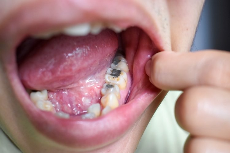 牙醫點名「6種食物」吃了沒馬上漱口、刷牙超容易蛀牙！