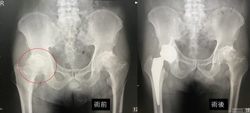 患者經人工全髖關節置換術治療前（左）後的X對照。圖／長安醫院提供