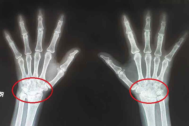 從劉女士手部X光片可看出骨骼結構破壞及變形，手腕動作受限，確診類風濕性關節炎。 ...