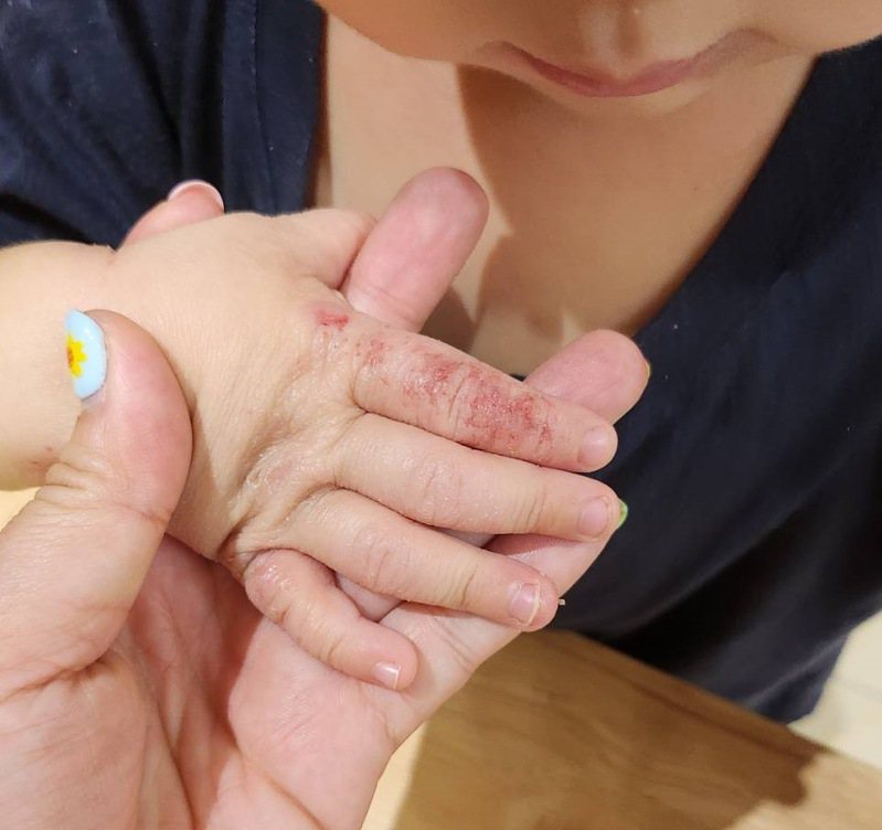 新北一名1歲多男童因異位性皮膚炎發作搔癢難耐，不只抓破皮流血，甚至引發傷口發炎流膿，嚴重影響睡眠品質與生活作息。圖／雙和醫院提供