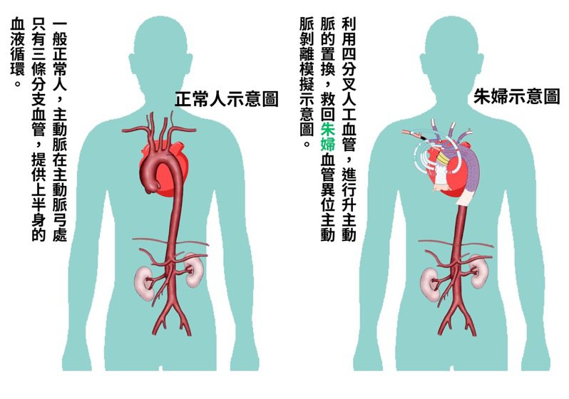 示意模擬圖：一般正常人主動脈在主動脈弓處只有三條分支血管，提供上半身的血液循環；朱婦卻比一般人多出一條分支主動脈剝離。圖／嘉義大林慈濟醫院提供
