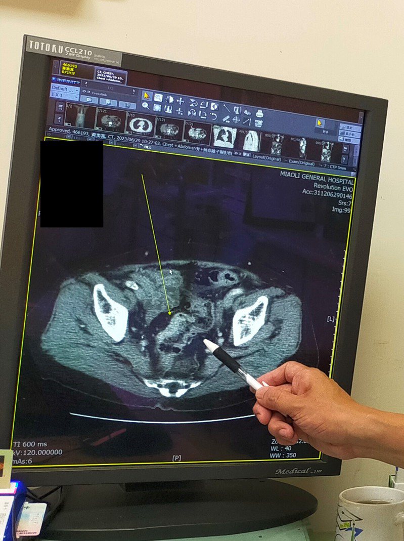 部立苗栗醫院直腸外科主任鄭智元表示，電腦斷層影像可幫助釐清癌細胞擴散或轉移程度。圖／苗栗醫院提供