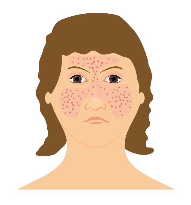 紅斑性狼瘡患者臉部的蝴蝶斑特徵  圖/123RF