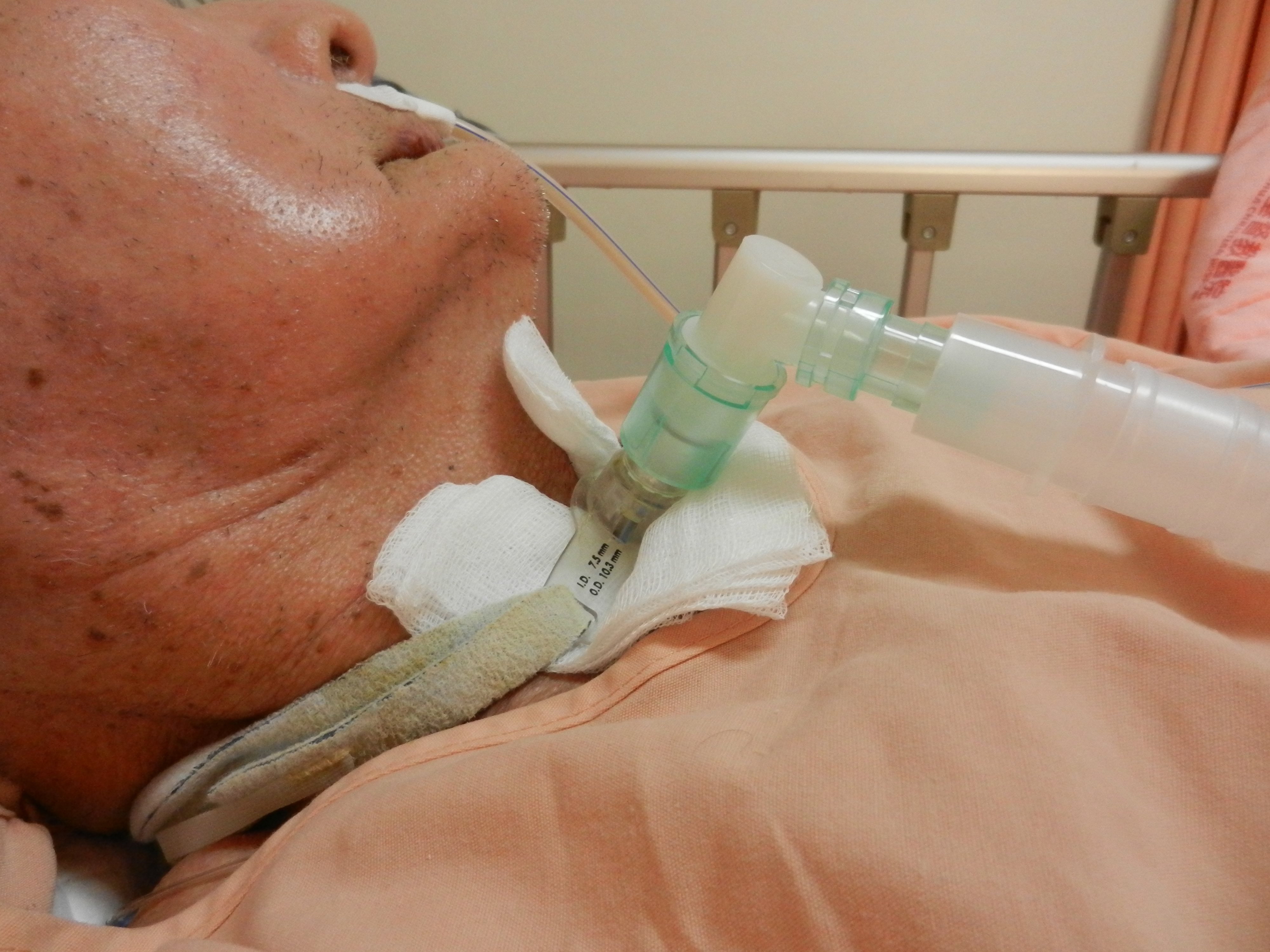 病患接受氣管切開術。圖／洪彩娥提供