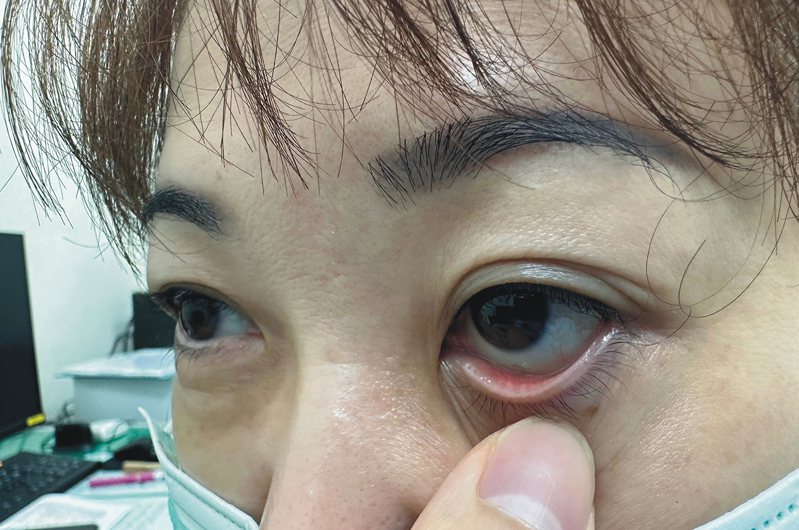 黃斑部病變主因為眼睛衰退老化所致，常見先在左右其中一眼發生，又分為乾性及濕性黃斑部病變。本報資料照片