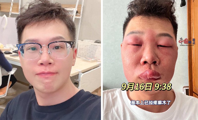 北京一名長相斯文的男子，因長期挖鼻孔導致鼻腔黏膜受損，而感染丹毒，其面部亦受此影響腫脹成「豬頭」模樣。（影片截圖）