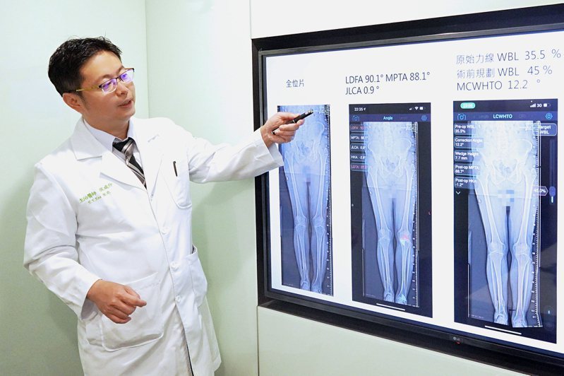 聯新國際醫院骨科主任侯咸仰（見圖）利用3D列印截骨矯正手術，幫助病患腳踝恢復正常...