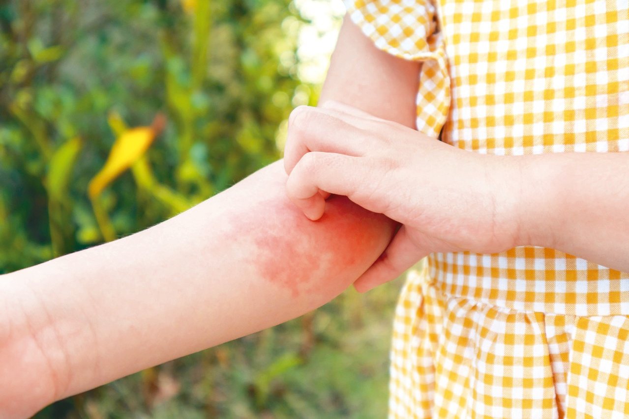 異位性皮膚炎是一個會反覆發作，讓病友困擾不已的慢性發炎疾病，平日細心照護肌膚和用藥不可忽視。示意圖，圖片來源：123RF。