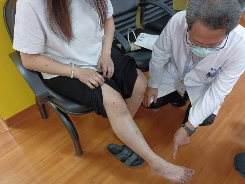 蕭姓病人的雙腿很多紅疹。記者簡慧珍／攝影