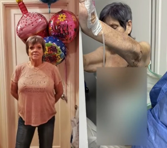 美國一名65歲婦女金柏莉（Kimberly McCormick）在墨西哥一間醫院進行拉皮手術，卻莫名被隆乳和提臀，還因此多了75,000美元（約台幣236萬元）債務。圖／擷自《FOX 13 Seattle》