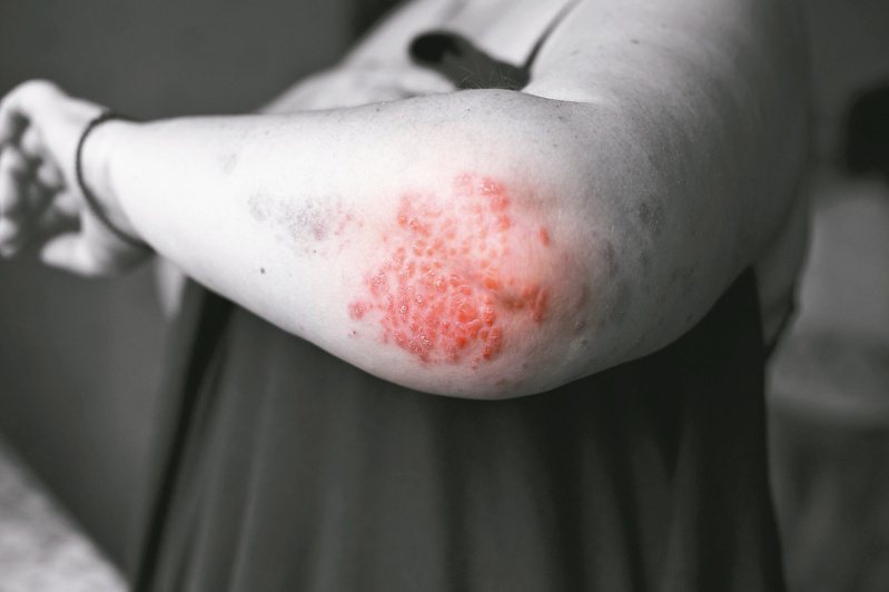 天疱瘡好發於50至60歲中老年人，是一種嚴重皮膚黏膜自體免疫水疱性疾病，有慢性、會復發且無法治癒的特性。圖／123RF