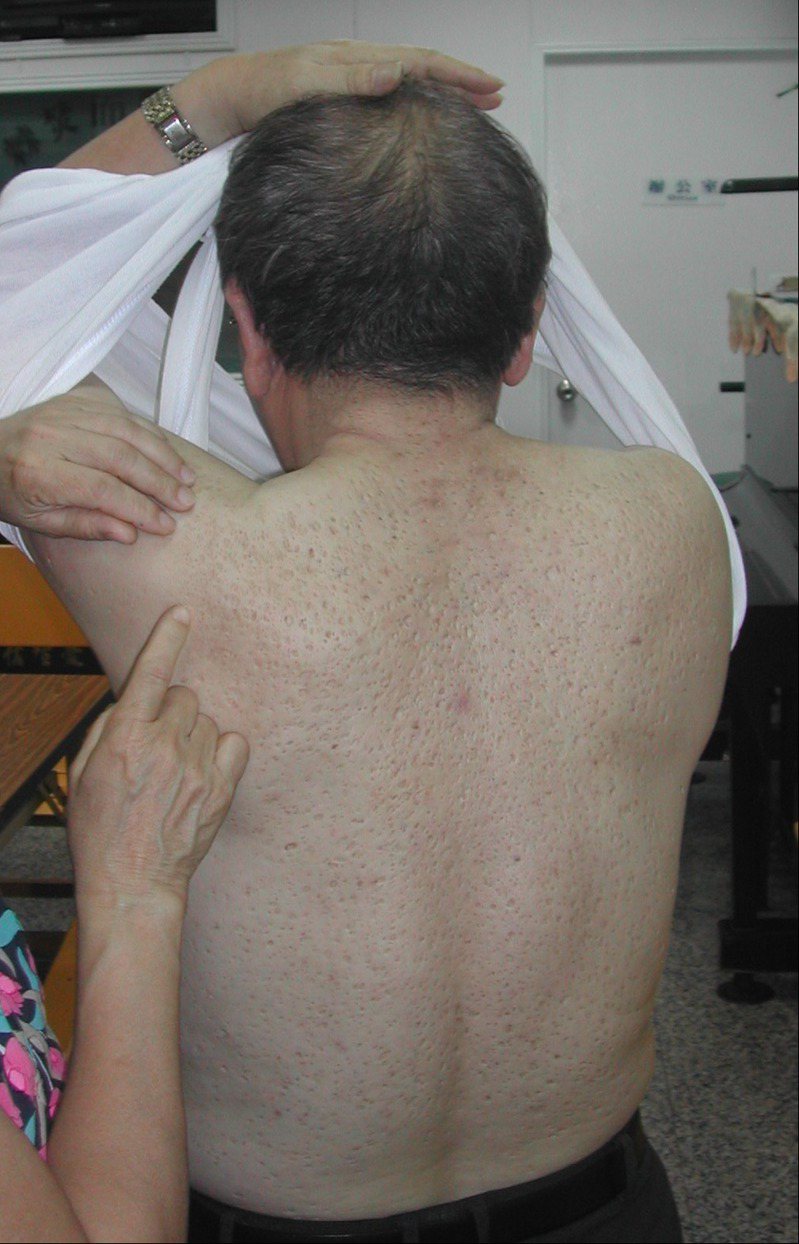 圖為多氯聯苯油症受害者，全背膿疤令他痛苦。本報資料照片