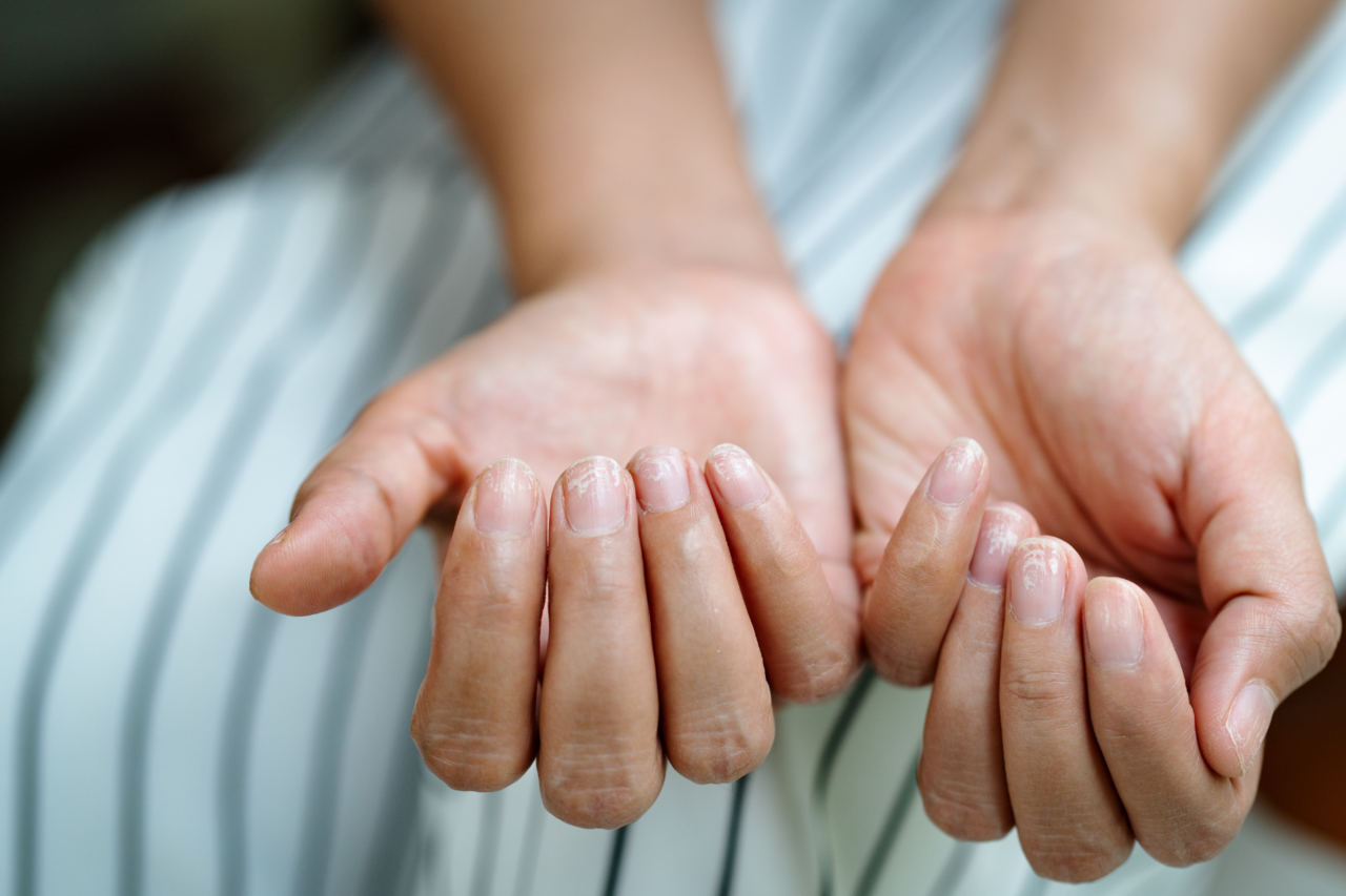 常見問題指甲的發生，主要原因多與天生指甲薄容易斷裂、指甲過度修剪有關。圖片來源：Canva