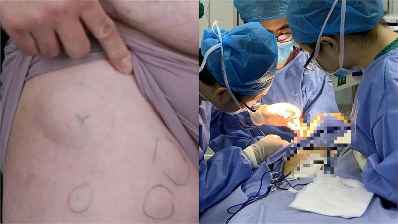 陳先生身上的「疙瘩 」，4名醫生同台為陳先生做手術切除脂肪瘤。圖／擷自《極目新聞》