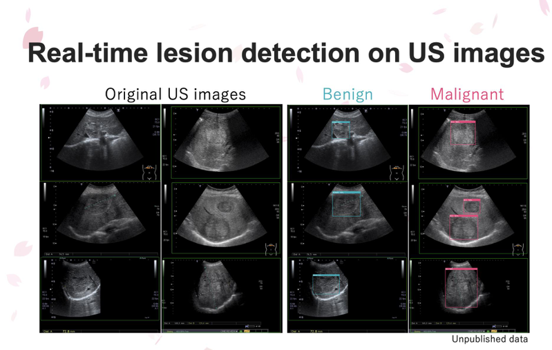 寻常的腹部超音波（图左蓝框处）只能约略找出可能的肿瘤病灶，但在AI即时超音波检查影像AI装置辅助下，九成的肿瘤病变（图右侧红框处）就能立即确认现形。图／好心肝基金会提供