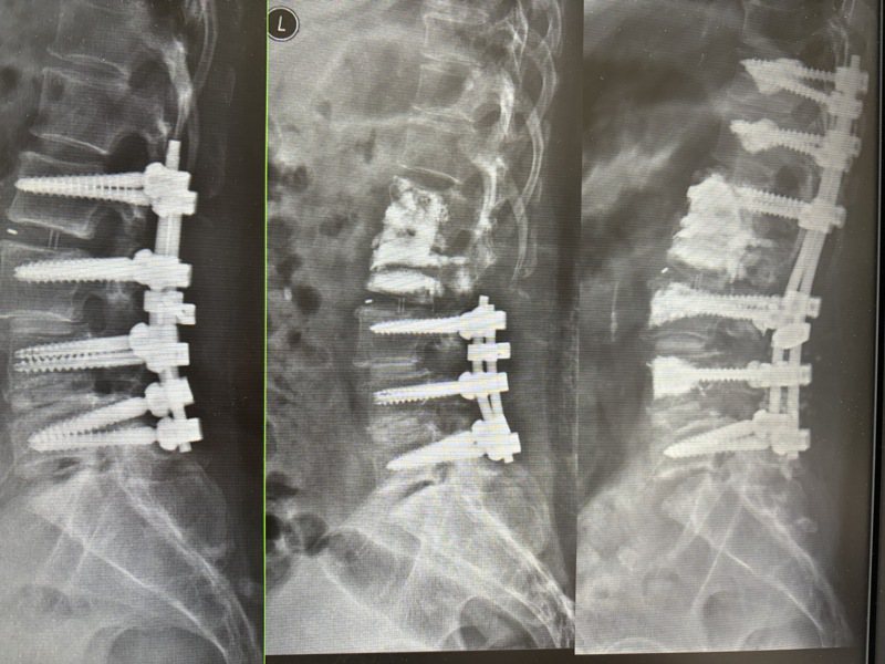 吴妇7年接受4次腰椎手术。图／中正脊椎骨科提供