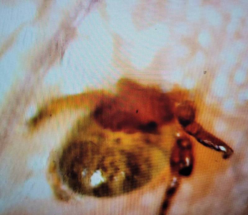 一名國小男童掃墓時眼睛刺痛不斷流淚，就醫後摘除發現竟是一隻恙蟲。圖／達特楊眼科聯盟提供