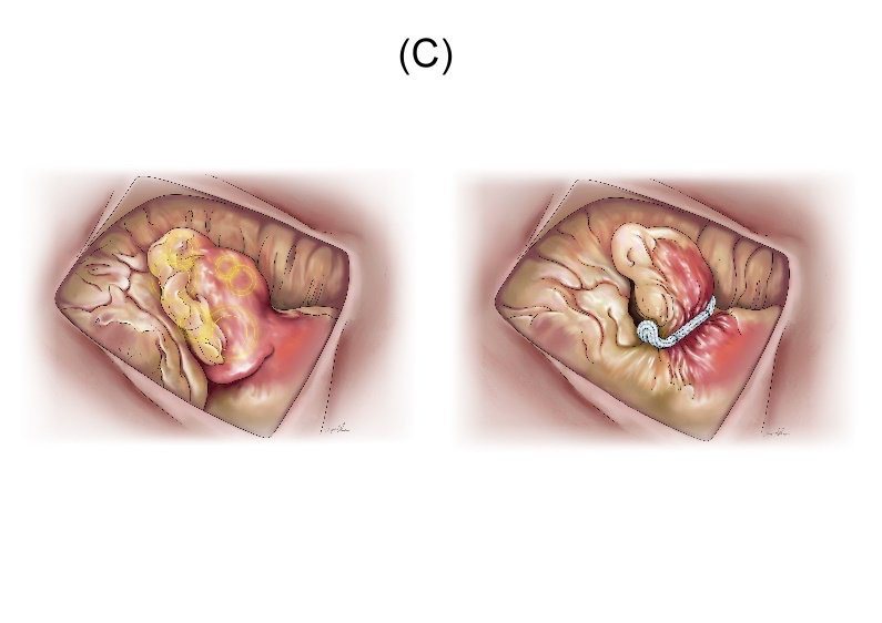胸腔镜左心耳关闭术(A)左胸侧边三个微创伤口(B)左心耳夹置入(C)超音波下确认完成。图／长庚医院提供