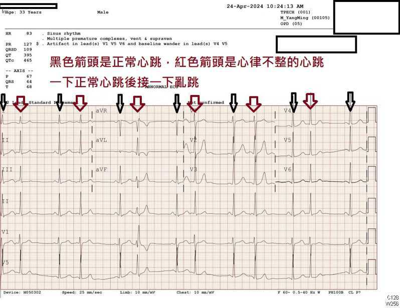 一名30歲的男性患者，在0403花蓮大地震之後出現心律不整問題，一跳正常的心跳後面緊接一跳亂跳的心跳。圖／取自蘇一峰臉書
