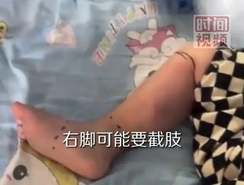 市場摸一下魚感卻染致命「弧菌」，珠海2歲男童右腳恐截肢。（取自微博影片截圖）