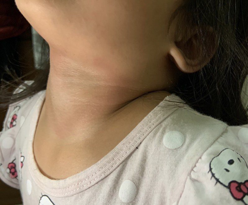 台东传2岁女童日前在幼儿园疑和同学抢夺玩具后嬉戏拉扯，导致女童脖子瘀伤。图／民众提供
