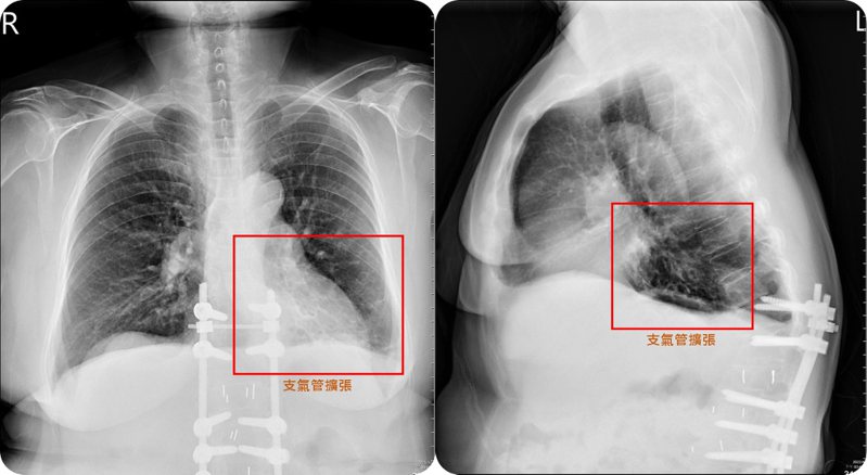 医师谢逸安说明，简姓妇人左下肺部的支气管严重扩张，出现各种不适症状。图／亚大医院提供