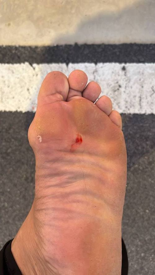 马来西亚有男子晨跑时，不幸踩中被插在路边的铁钉，误伤手脚。图／撷自X(photo:UDN)