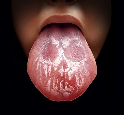 舌 癌 原因